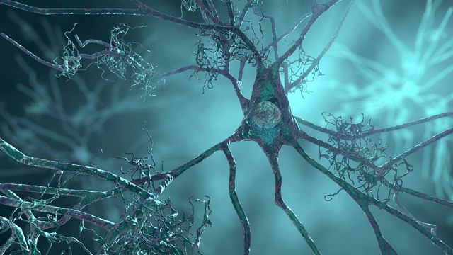 3D rendering of a degenerating neuron, illustrating nerve cell damage linked to Alzheimer's disease. 