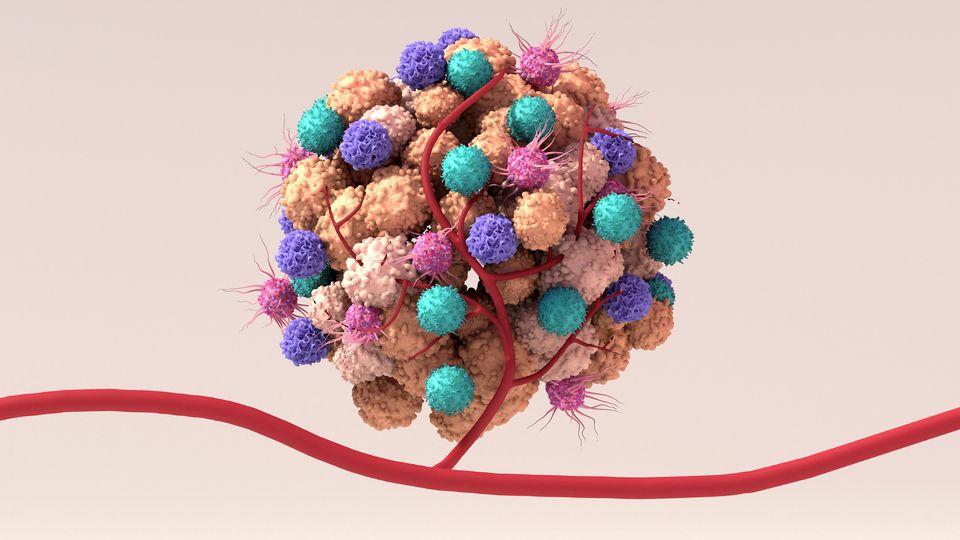 3D illustration of a solid tumor with various immune cells and blood vessels surrounding it.