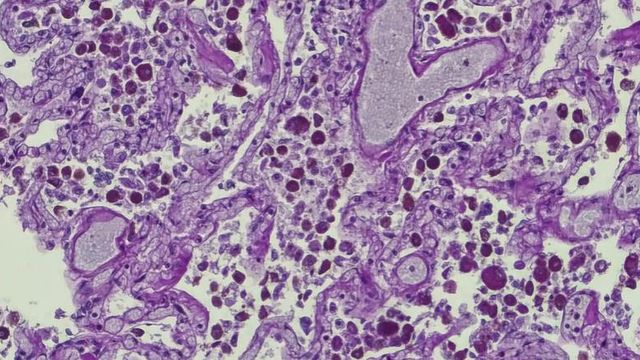 Microscopic view of lung tissue showing many dark-stained immune cells, thickened walls of air sacs and signs of inflammation 